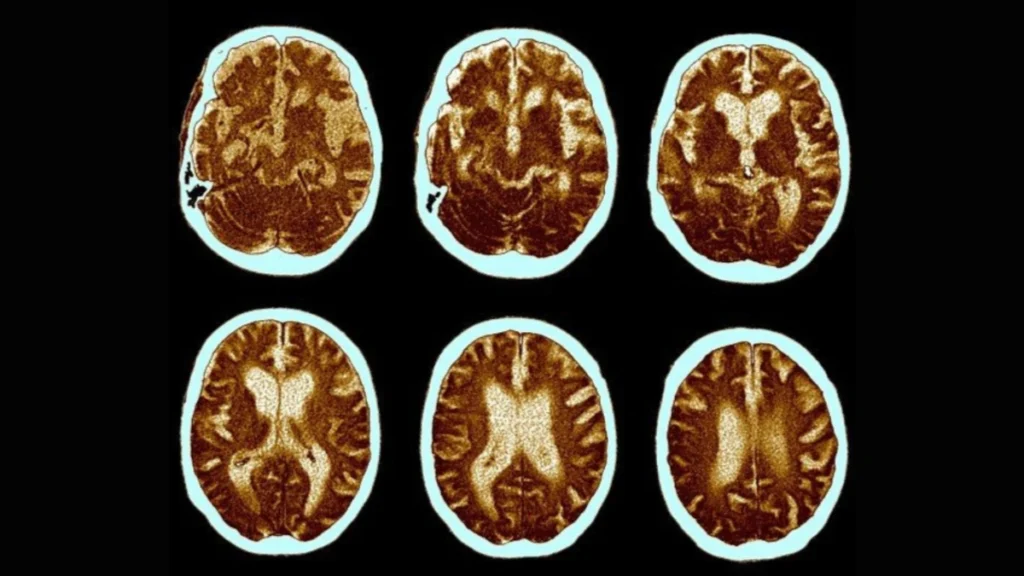 'First noticeable sign' of Dementia that often Appears Before Memory Loss—Study Reveals
